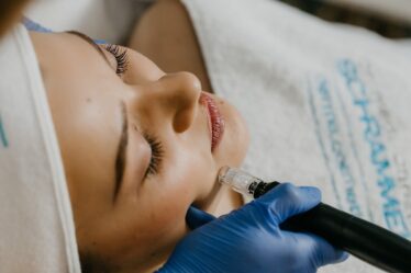Laser Treatment for Acne Scars