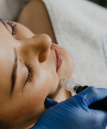 Laser Treatment for Acne Scars