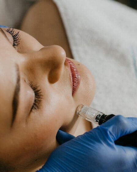 Laser Treatment for Acne Scars