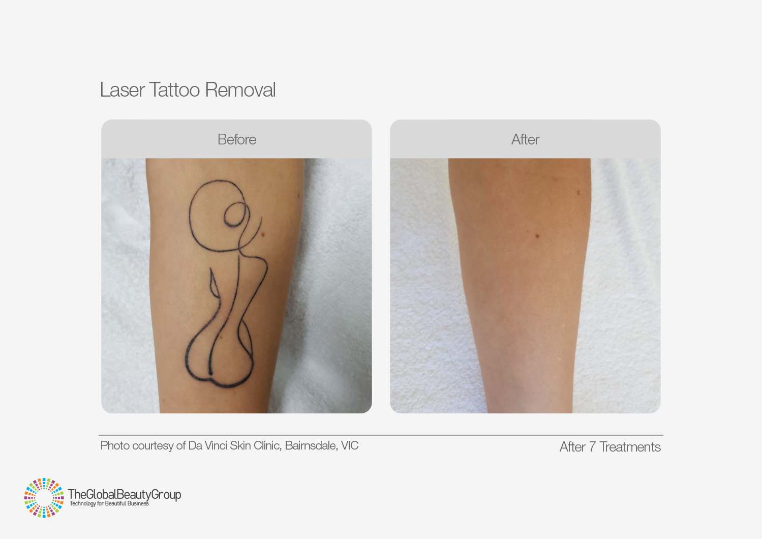 tattoo laser removal machines