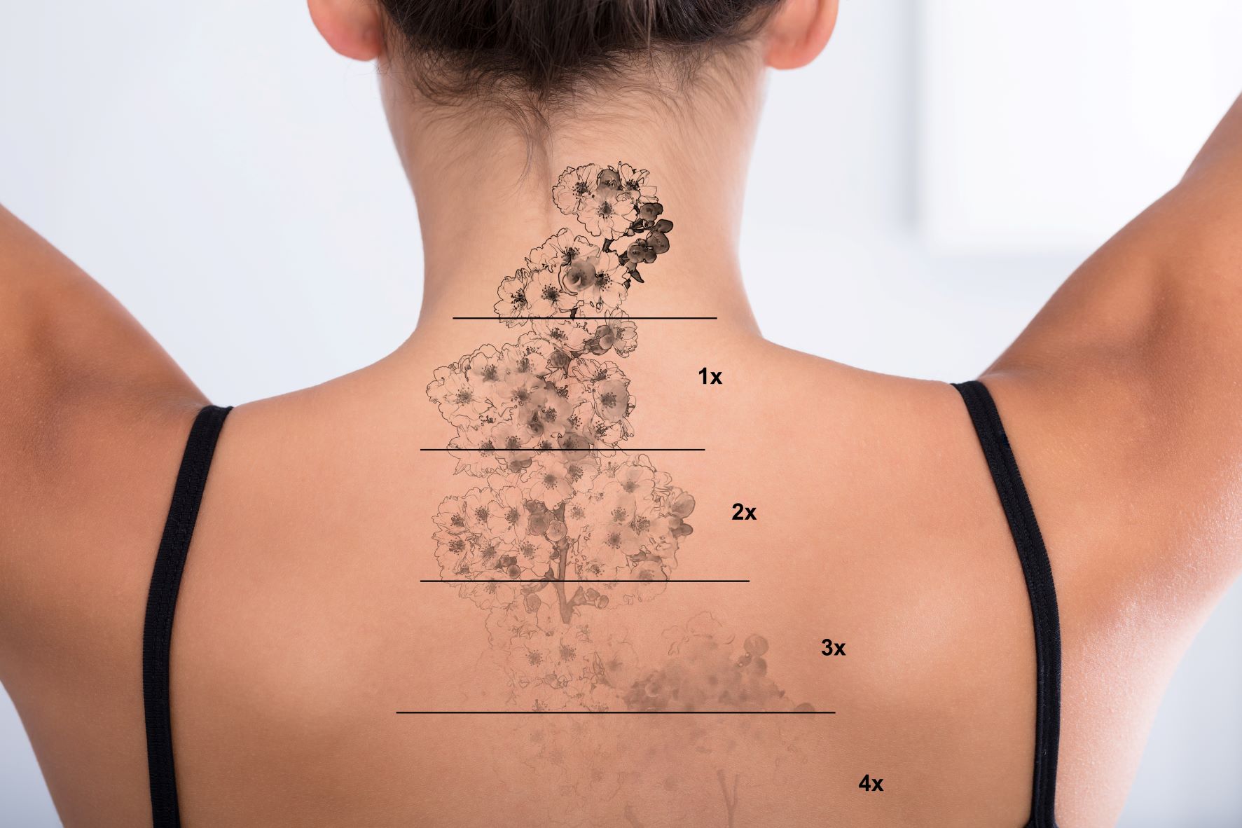 tattoo laser removal machines